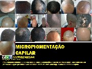 Micropigmentação capilar